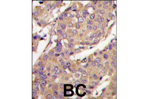 Formalin-fixed and paraffin-embedded human breast carcinoma tissue reacted with UBE2L6 polyclonal antibody  , which was peroxidase-conjugated to the secondary antibody, followed by DAB staining.