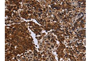 The image on the left is immunohistochemistry of paraffin-embedded Human liver cancer tissue using ABIN7190664(FMN2 Antibody) at dilution 1/30, on the right is treated with synthetic peptide. (Formin 2 antibody)