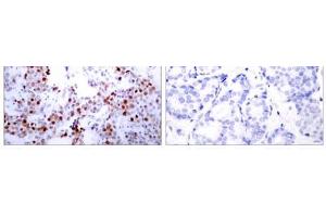 Immunohistochemical analysis of paraffin-embedded human breast carcinoma tissue using ATF-2 (Ab-62 or 44) antibody (E021029). (ATF2 antibody)