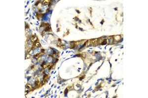 Immunohistochemistry of paraffin-embedded human gastric cancer using SNCA antibody at dilution of 1:100 (x40 lens). (SNCA antibody)