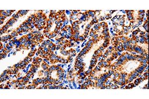 Immunohistochemistry of paraffin-embedded Human thyroid cancer tissue using COX19 Polyclonal Antibody at dilution 1:50 (COX19 antibody)