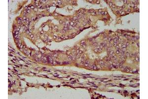 IHC image of ABIN7159857 diluted at 1:200 and staining in paraffin-embedded human endometrial cancer performed on a Leica BondTM system. (ENOSF1 antibody  (AA 171-286))