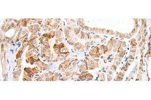 Immunohistochemistry of paraffin-embedded Human thyroid cancer tissue using HOXC11 Polyclonal Antibody at dilution of 1:25(x200) (HOXC11 antibody)