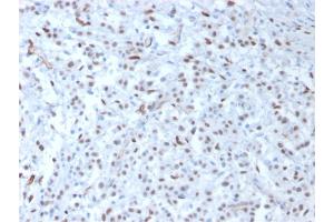 Formalin-fixed, paraffin-embedded human Mesothelioma stained with Wilm's Tumor Mouse Monoclonal Antibody (WT1/857). (WT1 antibody)