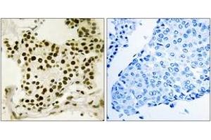 Immunohistochemistry analysis of paraffin-embedded human breast carcinoma, using UBF (Phospho-Ser484) Antibody.