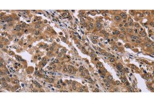 Immunohistochemistry of paraffin-embedded Human liver cancer tissue using FAM3B Polyclonal Antibody at dilution 1:40 (FAM3B antibody)