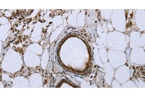 Immunohistochemistry of paraffin-embedded Human breast cancer using FBP1 Polyclonal Antibody at dilution of 1:40 (FBP1 antibody)