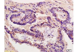 Formalin-fixed and paraffin embedded human colon carcinoma labeled with Anti-HSP90 alpha Polyclonal Antibody, Unconjugated (ABIN672021) at 1:200 followed by conjugation to the secondary antibody and DAB staining. (HSP90AB1 antibody  (AA 601-732))