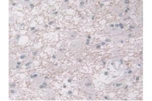 DAB staining on IHC-P;Samples:Human Glioma Tissue) (ORM1 antibody  (AA 19-201))