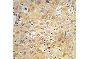 IHC analysis of FFPE human hepatocarcinoma tissue stained with ATG7 antibody (ATG7 antibody  (AA 22-51))
