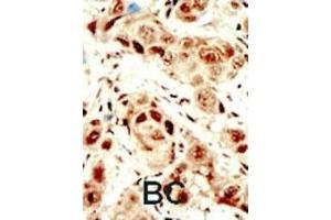 Formalin-fixed and paraffin-embedded human cancer tissue reacted with the primary antibody, which was peroxidase-conjugated to the secondary antibody, followed by DAB staining. (PIK3CA antibody  (C-Term))