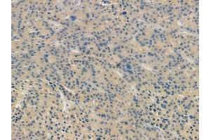 ABIN7094177 and ABIN7098222 at 1/100 staining human hepatocellular carcinoma by IHC-P. (DNM2 antibody  (C-Term))