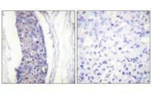 Immunohistochemistry analysis of paraffin-embedded human breast carcinoma tissue using Tubulin α antibody. (TUBA1A antibody  (C-Term))