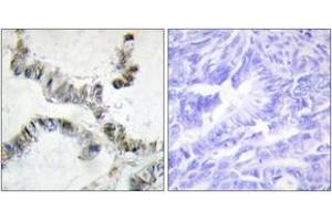 Immunohistochemistry analysis of paraffin-embedded human colon carcinoma, using SMF Antibody. (SNRPF antibody  (AA 131-180))