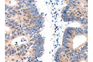 The image on the left is immunohistochemistry of paraffin-embedded Human colon cancer tissue using ABIN7130064(LAT2 Antibody) at dilution 1/15, on the right is treated with fusion protein. (LAT2 antibody)