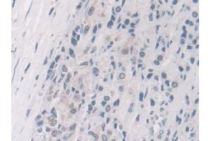 Detection of FKBP4 in Human Prostate cancer Tissue using Polyclonal Antibody to FK506 Binding Protein 4 (FKBP4) (FKBP4 antibody  (AA 2-459))