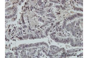 Immunoperoxidase of monoclonal antibody to FOXO3A on formalin-fixed paraffin-embedded human colon adenocarcinoma. (FOXO3 antibody  (AA 361-460))