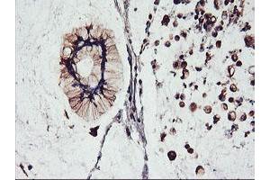 Immunohistochemical staining of paraffin-embedded Adenocarcinoma of Human colon tissue using anti-FBXO21 mouse monoclonal antibody. (FBXO21 antibody)