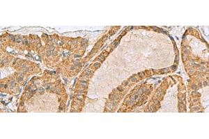 Immunohistochemistry of paraffin-embedded Human thyroid cancer tissue using PREPL Polyclonal Antibody at dilution of 1:55(x200) (PREPL antibody)