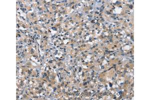 Immunohistochemistry of Human thyroid cancer using DDR2 Polyclonal Antibody at dilution of 1:40 (DDR2 antibody)
