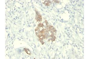 Formalin-fixed, paraffin-embedded human Breast Carcinoma stained with RET Mouse Monoclonal Antibody (RET/2795).