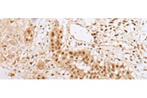 Immunohistochemistry of paraffin-embedded Human colorectal cancer tissue using ZNF22 Polyclonal Antibody at dilution of 1:25(x200) (Zinc Finger Protein 22 antibody)