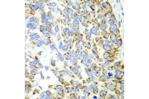 Immunohistochemistry of paraffin-embedded human esophageal cancer using CHIA antibody (ABIN5971776) at dilution of 1/100 (40x lens). (CHIA antibody)