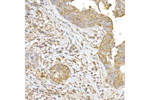 Immunohistochemistry of paraffin-embedded human colon carcinoma using SOCS1 Rabbit pAb (ABIN6128737, ABIN6148263, ABIN6148266 and ABIN6223700) at dilution of 1:250 (40x lens). (SOCS1 antibody  (AA 1-211))