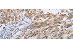 Immunohistochemistry of paraffin-embedded Human esophagus cancer tissue using ZIC5 Polyclonal Antibody at dilution of 1:100(x200)