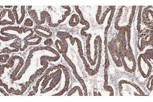 IHC-P Image Immunohistochemical analysis of paraffin-embedded human ovarian cancer, using ACADM, antibody at 1:100 dilution. (Medium-Chain Specific Acyl-CoA Dehydrogenase, Mitochondrial (C-Term) antibody)