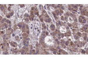 ABIN6273877 at 1/100 staining Human liver cancer tissue by IHC-P. (Prostaglandin D2 Receptor 2 (PTGDR2) (Internal Region) antibody)