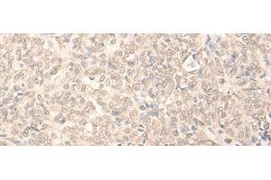 Immunohistochemistry of paraffin-embedded Human ovarian cancer tissue using RUVBL2 Polyclonal Antibody at dilution of 1:25(x200) (RUVBL2 antibody)