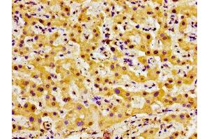 Immunohistochemistry of paraffin-embedded human liver cancer using ABIN7148001 at dilution of 1:100