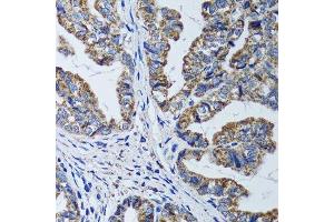 Immunohistochemistry of paraffin-embedded human gastric cancer using ATP5B antibody.