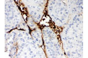 Anti-CA1 Picoband antibody, IHC(P) IHC(P): Human Liver Cancer Tissue (CA1 antibody  (AA 9-261))