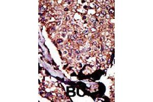 Formalin-fixed and paraffin-embedded human cancer tissue reacted with DGKB polyclonal antibody  , which was peroxidase-conjugated to the secondary antibody, followed by DAB staining. (DGKB antibody  (C-Term))