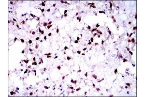 Immunohistochemical analysis of paraffin-embedded brain tumors tissues using PAX5 mouse mAb with DAB staining. (PAX5 antibody  (AA 235-382))