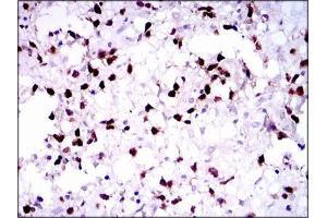 Immunohistochemical analysis of paraffin-embedded brain tumors tissues using PAX5 mouse mAb with DAB staining. (PAX5 antibody  (AA 235-382))