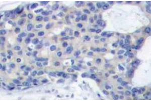 Immunohistochemistry (IHC) analyzes of p-ZAP-70 antibody in paraffin-embedded human breast carcinoma tissue. (ZAP70 antibody  (pTyr493))