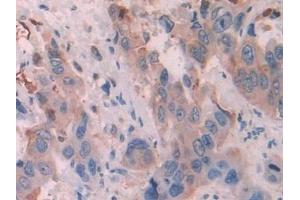 Detection of KRT6C in Human Breast cancer Tissue using Polyclonal Antibody to Keratin 6C (KRT6C) (Keratin 6C antibody  (AA 163-482))