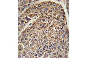 DLAT Antibody (C-term) (ABIN651534 and ABIN2840283) immunohistochemistry analysis in formalin fixed and paraffin embedded human hepatocarcinoma followed by peroxidase conjugation of the secondary antibody and DAB staining. (DLAT antibody  (C-Term))