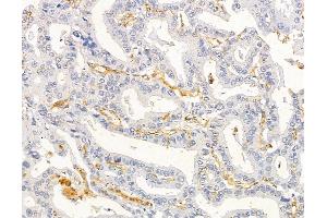 ABIN6263368 and ABIN6279540 at 1/100 staining human liver cancer by IHC-P. (MRPL33 antibody  (Internal Region))