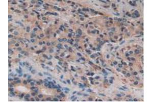 IHC-P analysis of Human Prostate Gland Cancer Tissue, with DAB staining. (FUCA1 antibody  (AA 53-289))
