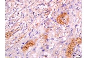 Formalin-fixed and paraffin embedded human lung carcinoma labeled with Anti-CD63/MLA1 Polyclonal Antibody, Unconjugated  at 1:200 followed by conjugation to the secondary antibody and DAB staining. (CD63 antibody  (AA 101-200))