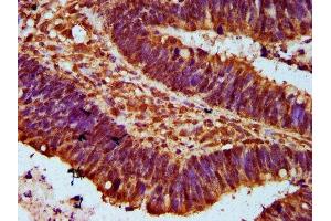 IHC image of ABIN7152566 diluted at 1:300 and staining in paraffin-embedded human ovarian cancer performed on a Leica BondTM system. (FAN1 antibody  (AA 167-373))