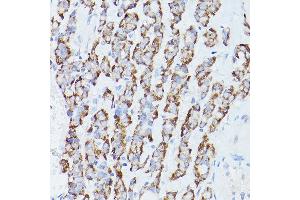 Immunohistochemistry of paraffin-embedded Human thyroid cancer using RPS18 antibody (ABIN6128660, ABIN6147205, ABIN6147206 and ABIN6215379) at dilution of 1:100 (40x lens).