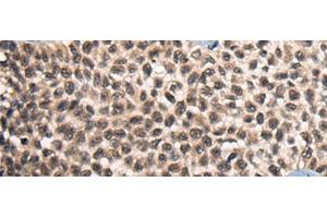 Immunohistochemistry of paraffin-embedded Human ovarian cancer tissue using CITED2 Polyclonal Antibody at dilution of 1:50(x200)