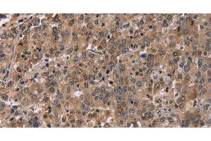 Immunohistochemistry of paraffin-embedded Human liver cancer tissue using FAM107A Polyclonal Antibody at dilution 1:30 (FAM107A antibody)