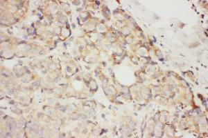 Anti-SCF antibody, IHC(P) IHC(P): Human Mammary Cancer Tissue (KIT Ligand antibody  (N-Term))