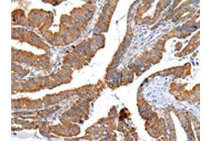 The image on the left is immunohistochemistry of paraffin-embedded Human esophagus cancer tissue using ABIN7193075(XKR4 Antibody) at dilution 1/20, on the right is treated with synthetic peptide. (XKR4 antibody)